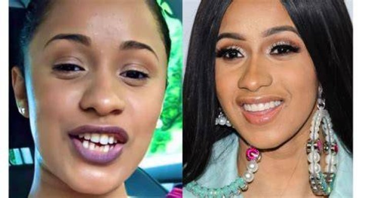 Cardi b teeth before and after cost, surgery, pictures