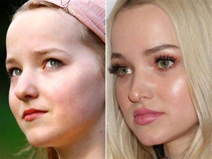 Dove Cameron Before and After From 2008 to 2020 The Skincare Edit