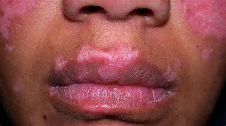 Lupus can cause a red butterflyshaped rash across the nose and cheeks