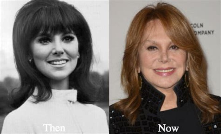 Marlo Thomas Botox Before And After Photos Did She Have A Facelift?